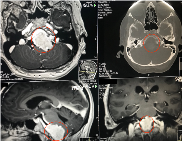 巨大巖斜區(qū)腦膜瘤全切案例一則